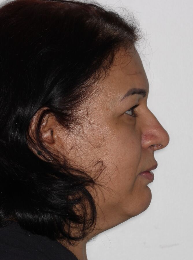 Paciente 02 depois
